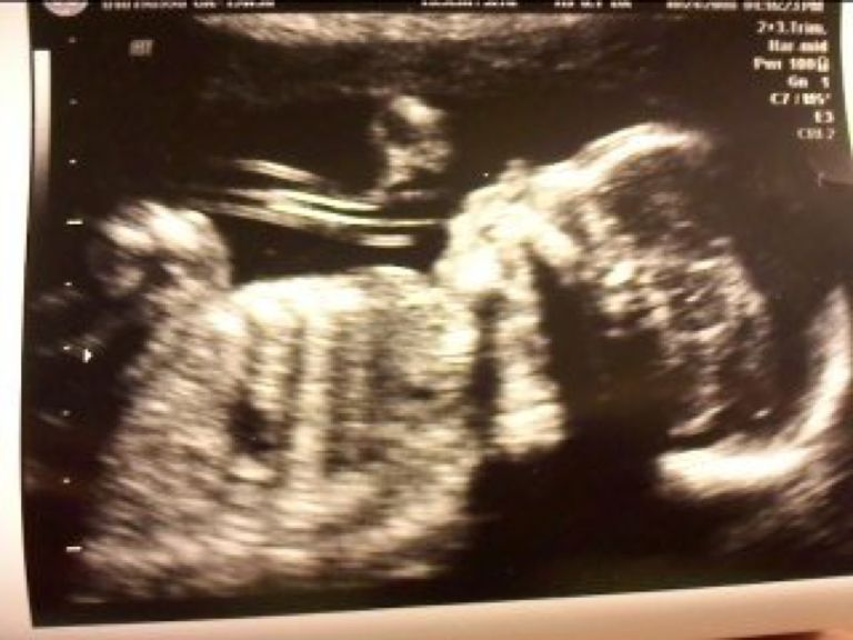 My fertility story